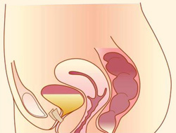 Urinary Incontinence